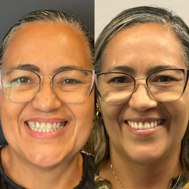 Resultado de tratamento odontológico realizado na Exclusive Odontologia (5)