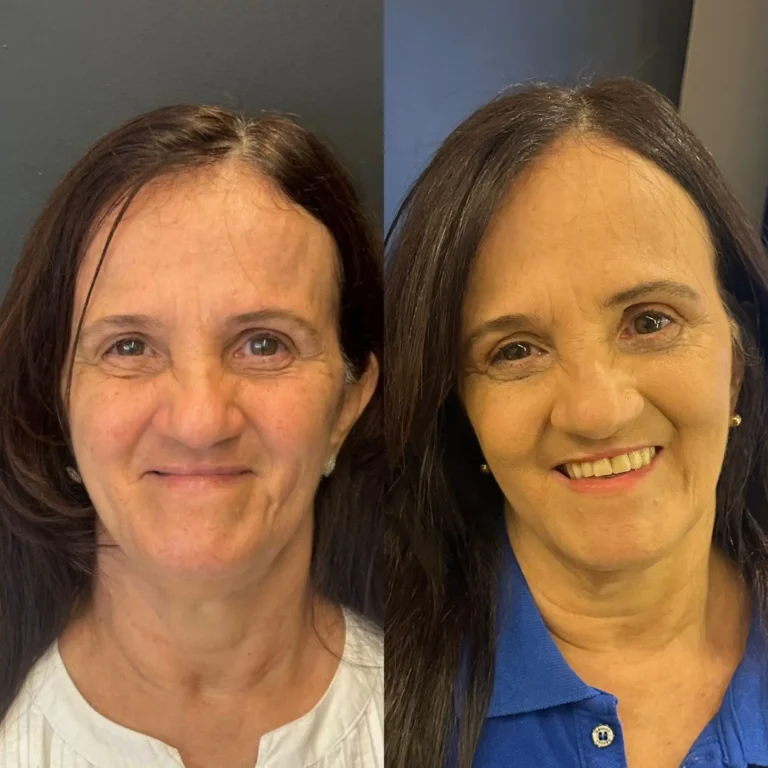 Resultado de tratamento odontológico realizado na Exclusive Odontologia (2)