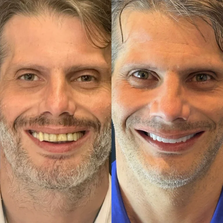 Resultado de tratamento odontológico realizado na Exclusive Odontologia (3)