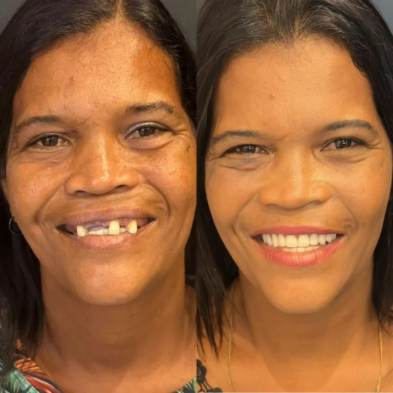 Resultado de tratamento odontológico realizado na Exclusive Odontologia (4)