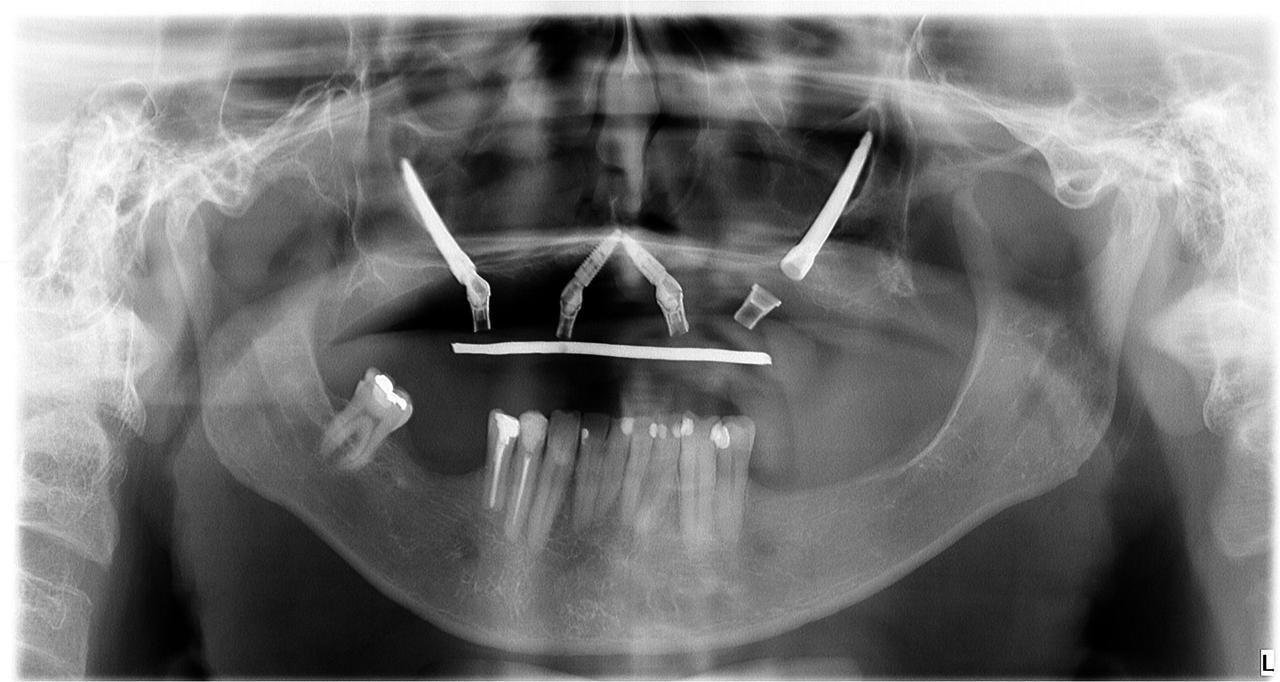 Radiografia após o implante zigomático