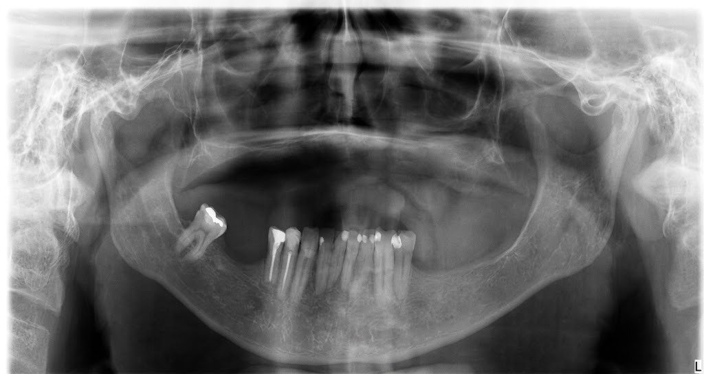 Radiografia antes do implante zigomático
